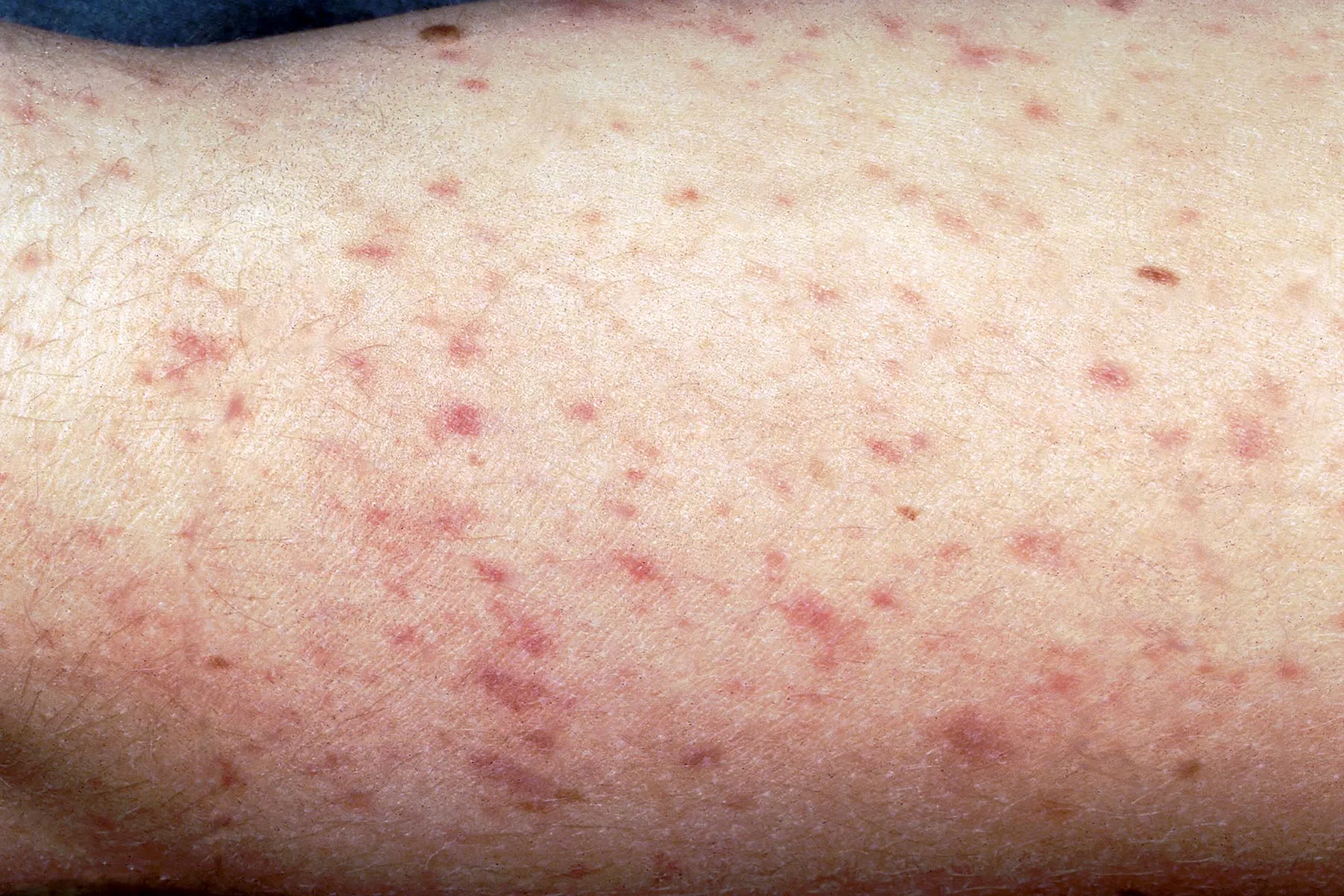 Spotting Meningitis: Key Symptoms & Why Early Action Matters